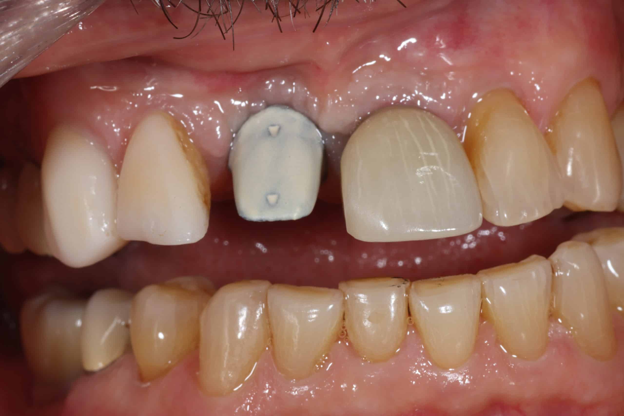 Implant before - Ivory Dental Aesthetics in Walnut Creek, CA